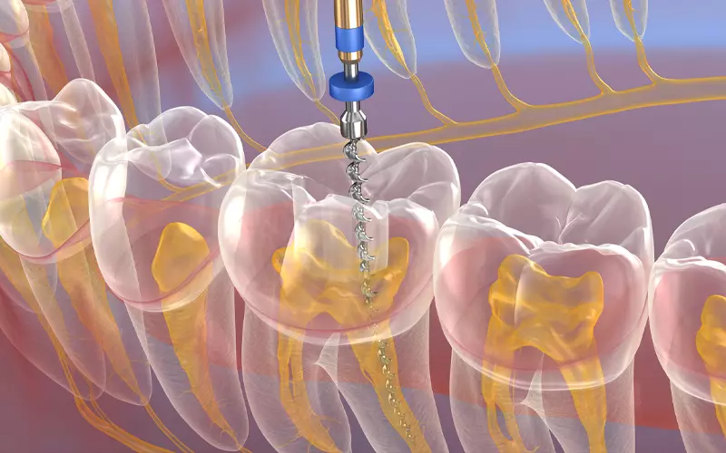 فرآیند درمان ریشه دندان (عصب‌کشی): از تشخیص تا بهبودی کامل